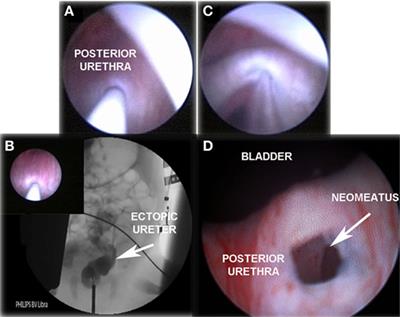 Endoscopic Urinary Diversion As Initial Management of Symptomatic Obstructive Ectopic Ureter in Infants